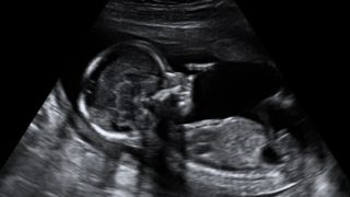 Ultrasound Amazing Baby 3D