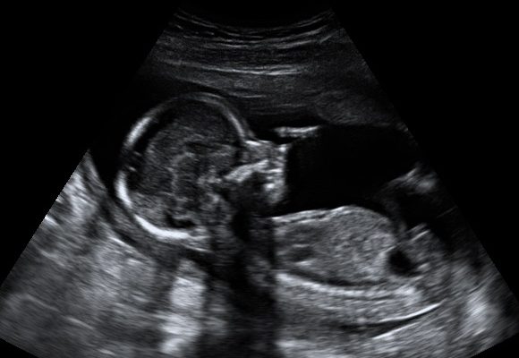 Ultrasound Amazing Baby 3D
